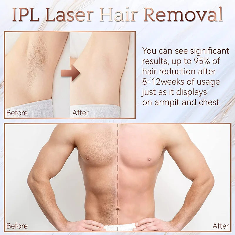 IPL Laser Hair Removal Device – 999,999 Flashes