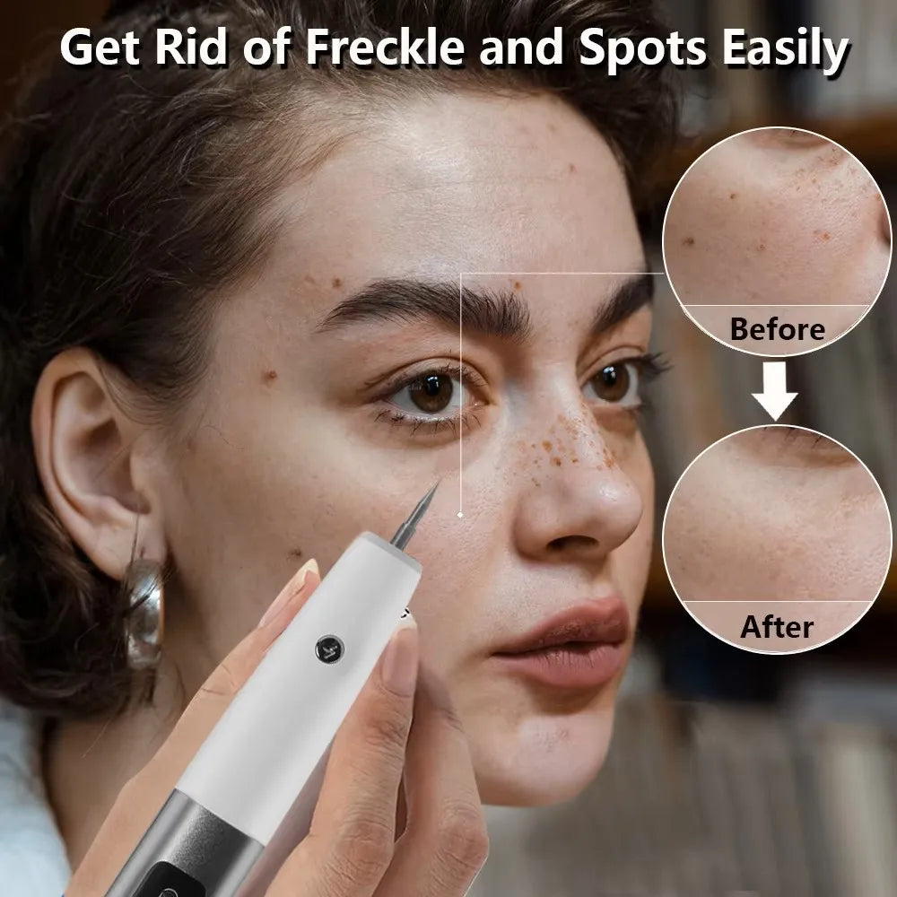 Electric Skin Tag & Mole Remover Pen