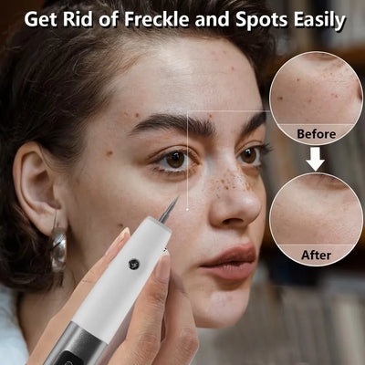 Electric Skin Tag & Mole Remover Pen