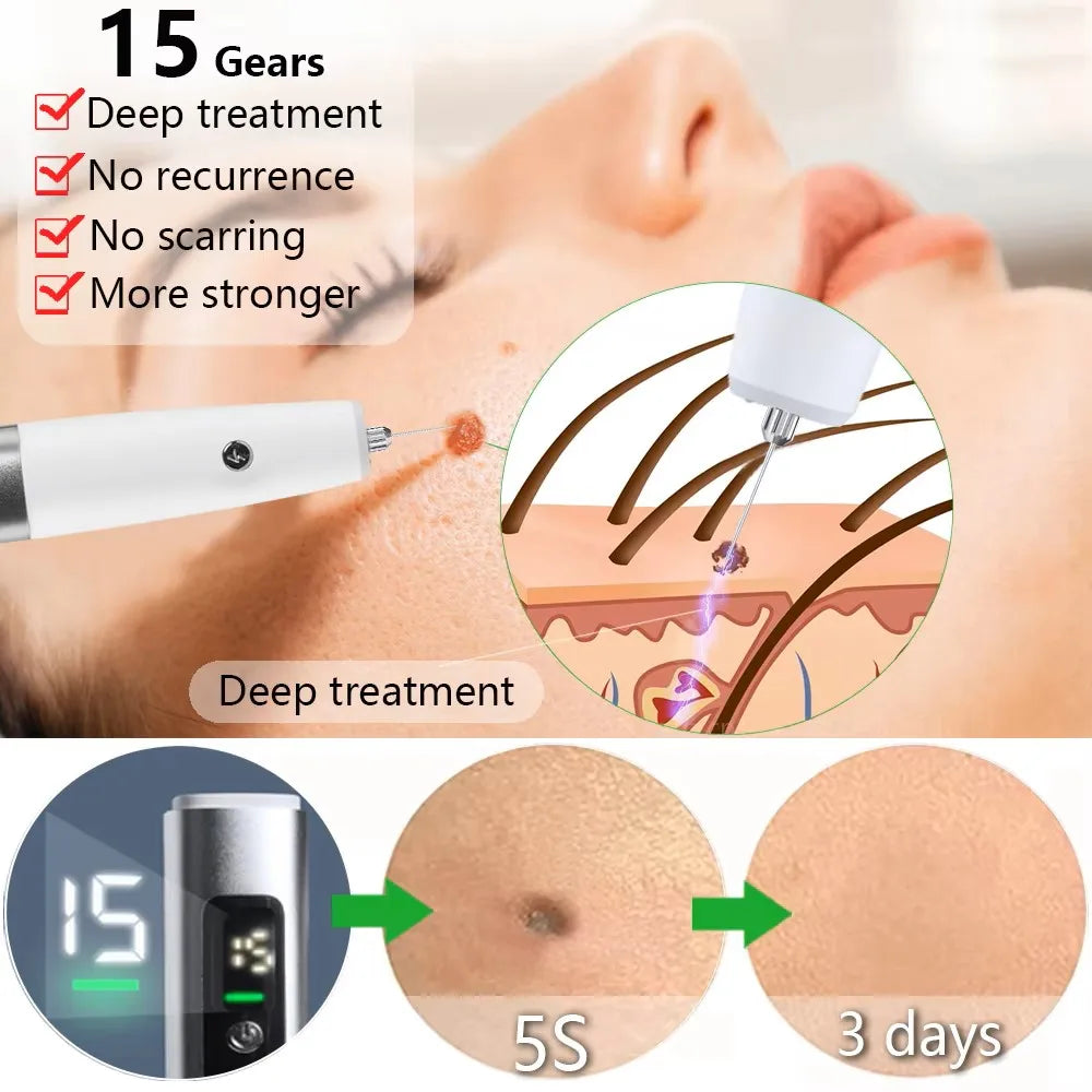 Electric Skin Tag & Mole Remover Pen